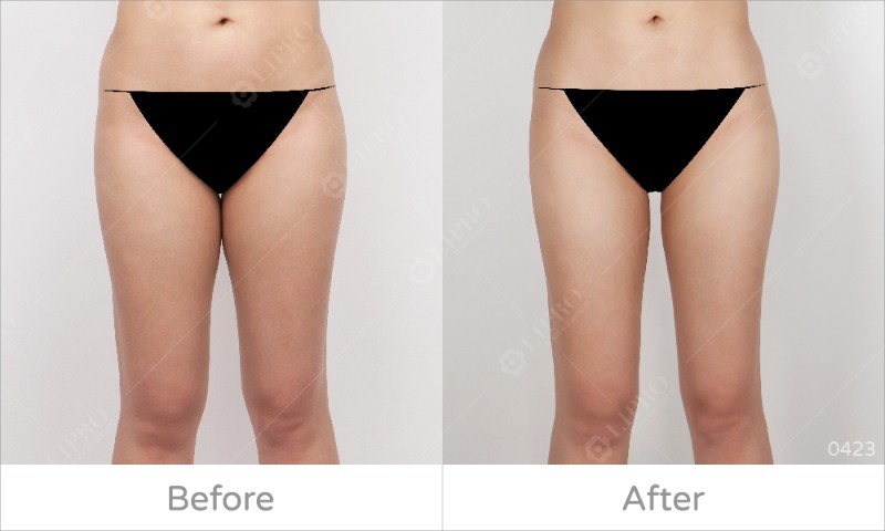 大腿內側曲線0423