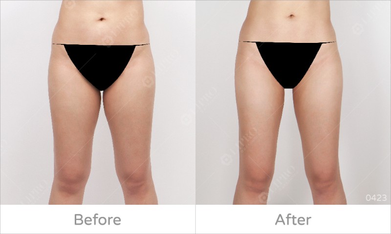 大腿內側曲線0423