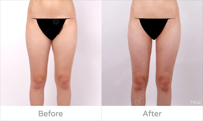 大腿內側7432