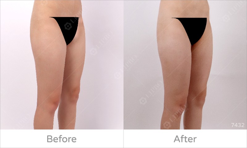 大腿內側7432