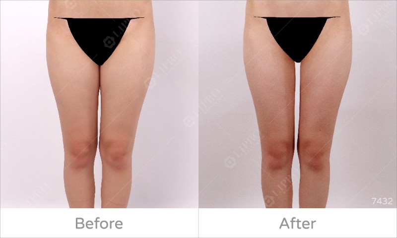 大腿內側7432