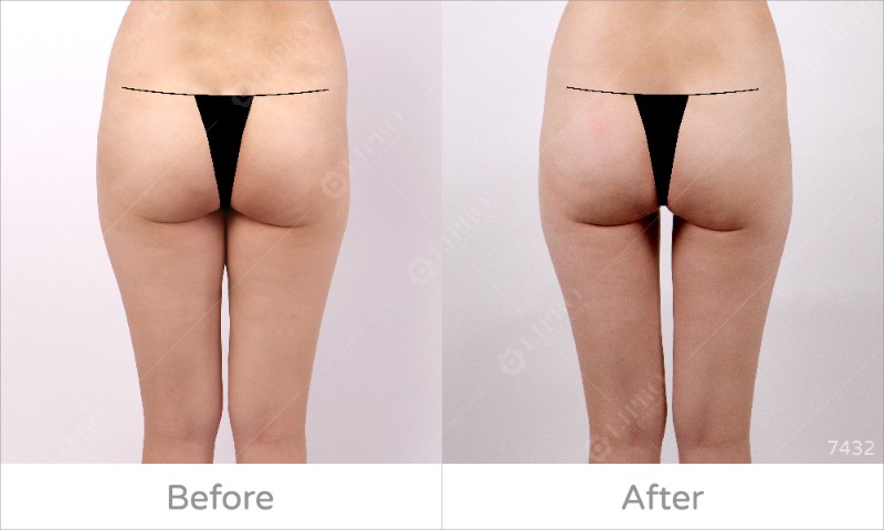 大腿內側7432