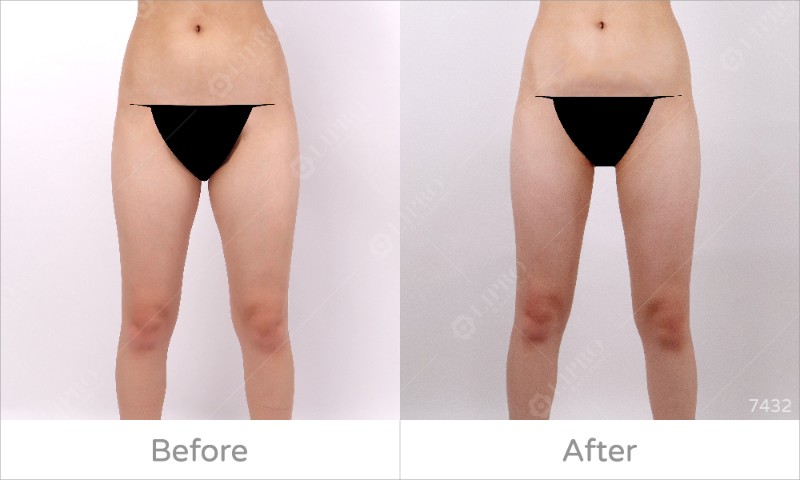 大腿內側7432