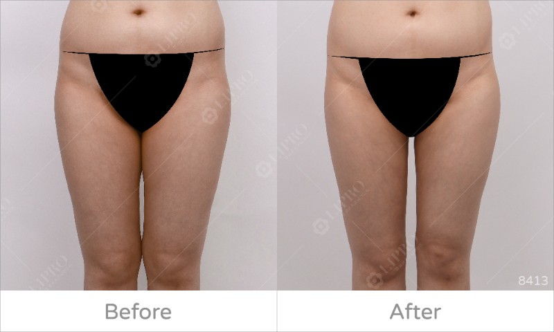 大腿內側8413