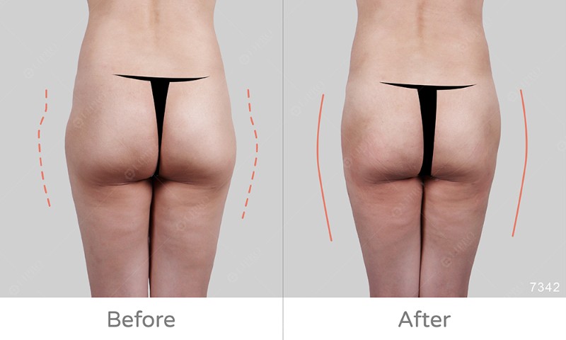 臀部曲線凹凸修復7342