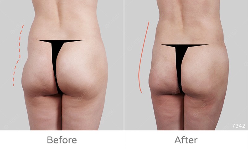 臀部曲線凹凸修復7342