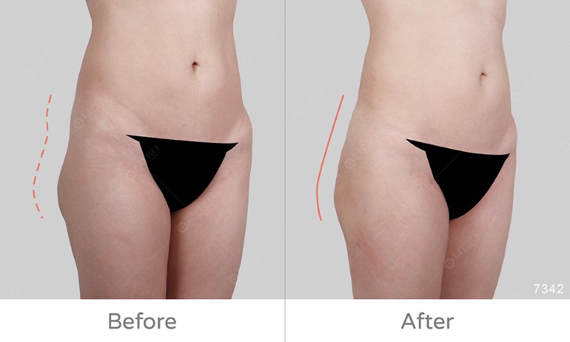 臀部曲線凹凸修復7342