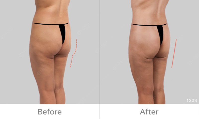 下半身凹凸抽脂修復1303