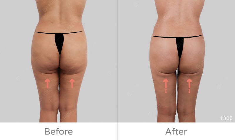 下半身凹凸抽脂修復1303