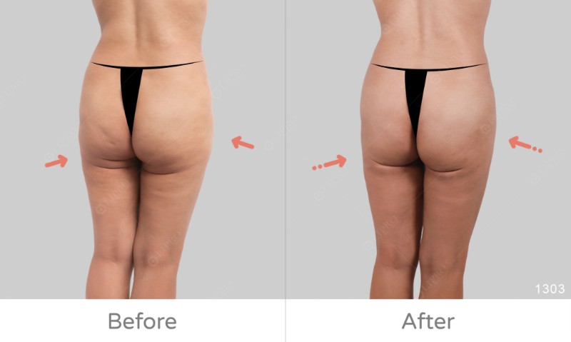 下半身凹凸抽脂修復1303