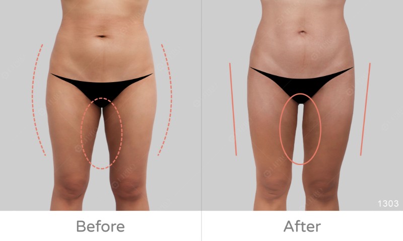 下半身凹凸抽脂修復1303