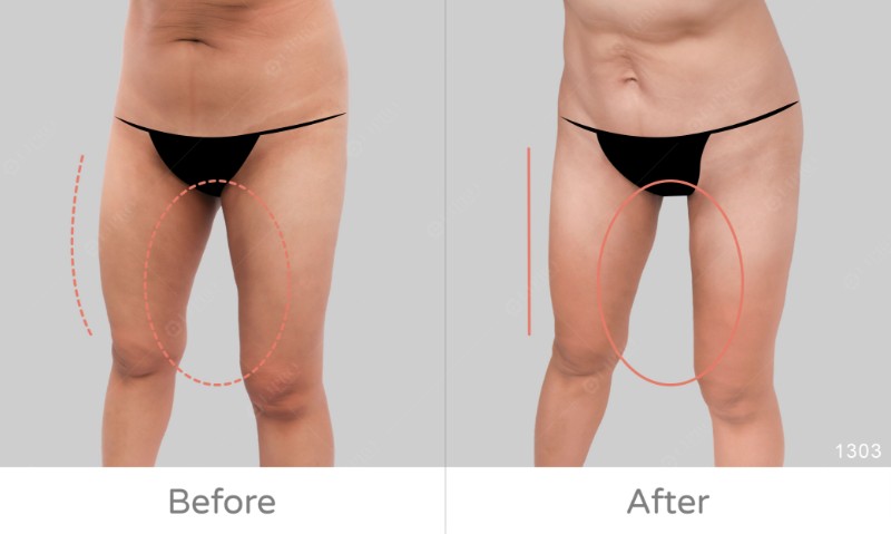 下半身凹凸抽脂修復1303