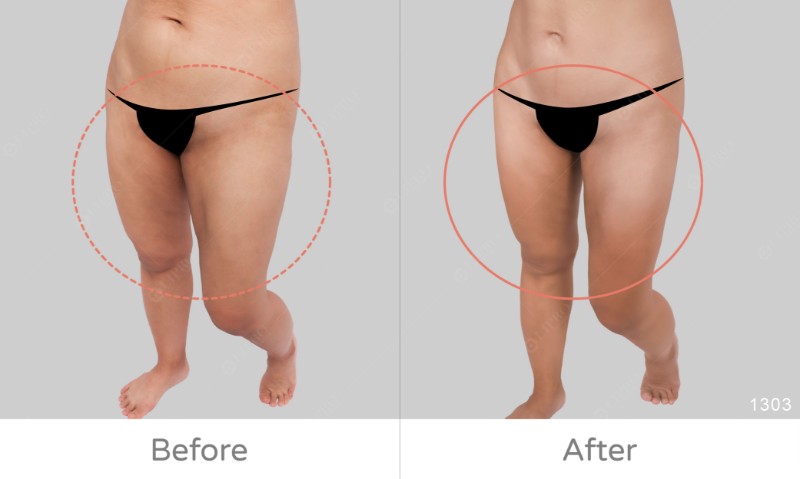 下半身凹凸抽脂修復1303