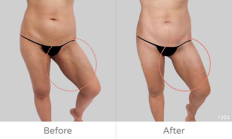 下半身凹凸抽脂修復1303