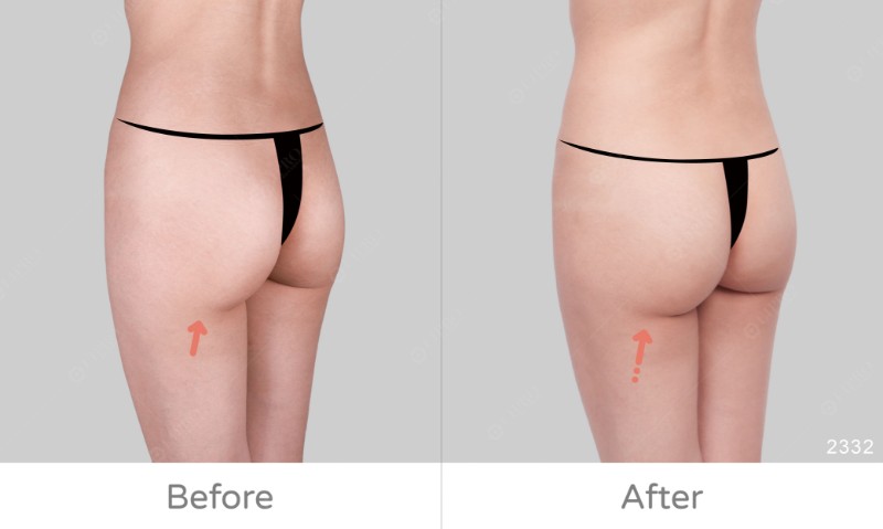 腿外臀2332