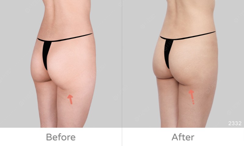 腿外臀2332