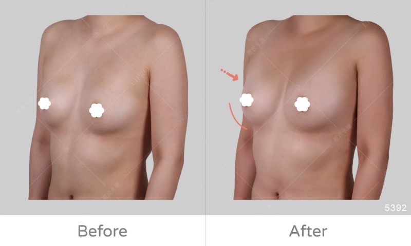 自體豐胸5392