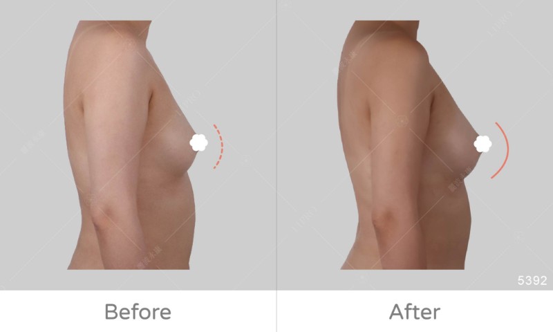 自體豐胸5392