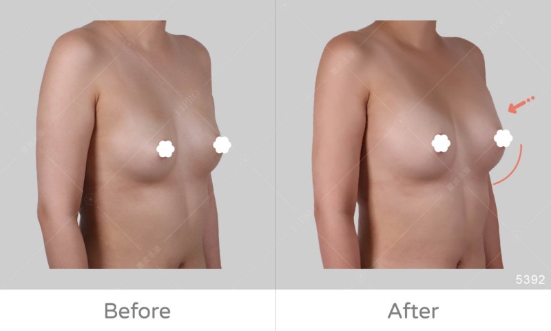 自體豐胸5392