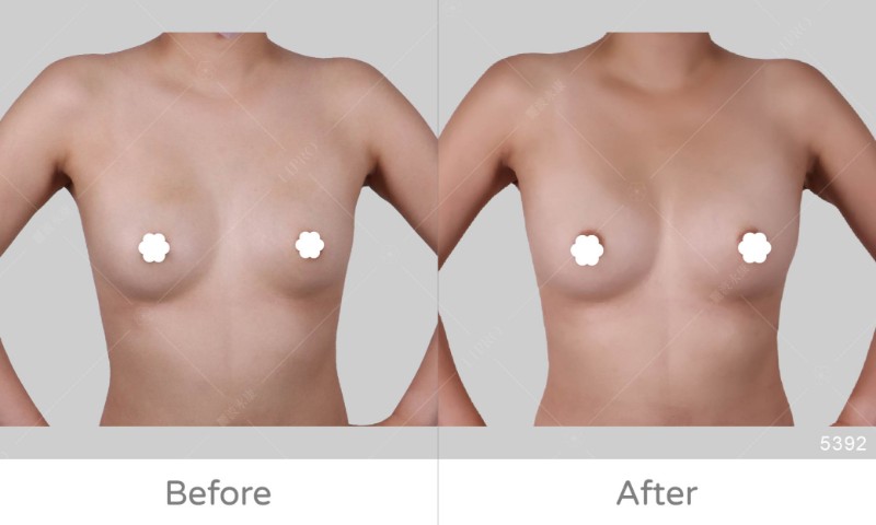 自體豐胸5392