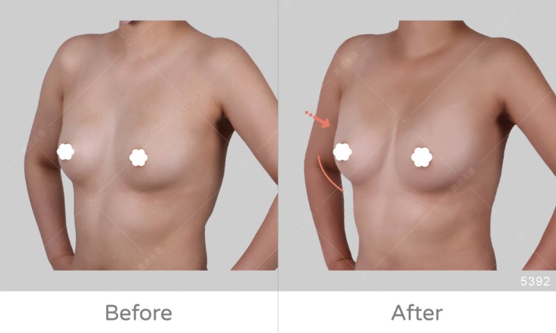 自體豐胸5392