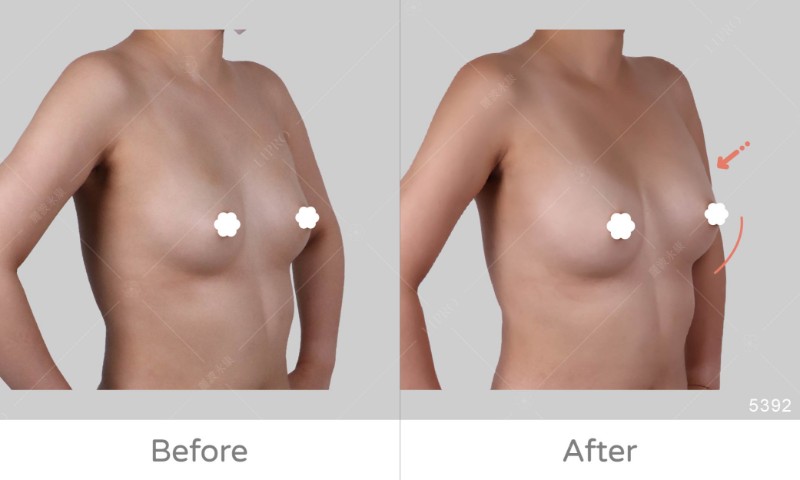 自體豐胸5392