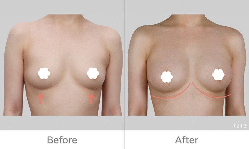 自體脂肪豐胸7213