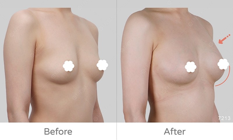 自體脂肪豐胸7213