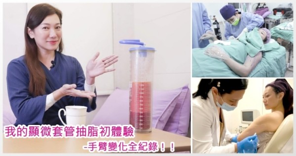 我的顯微套管抽脂初體驗，手臂變化全紀錄｜親子天下作者葉淇淇