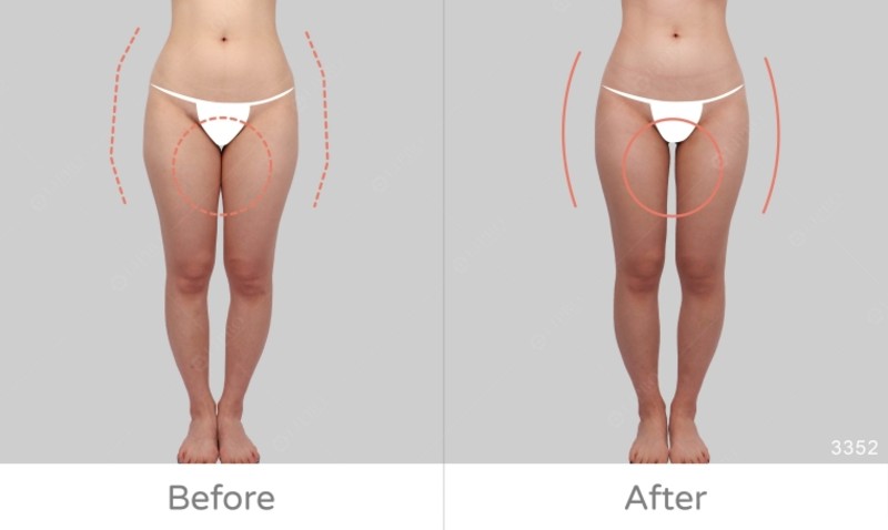 臀腿抽脂｜空姐婚前搶救大腿內側脂肪堆積