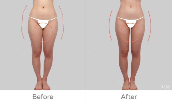 臀腿抽脂｜空姐婚前搶救大腿內側脂肪堆積