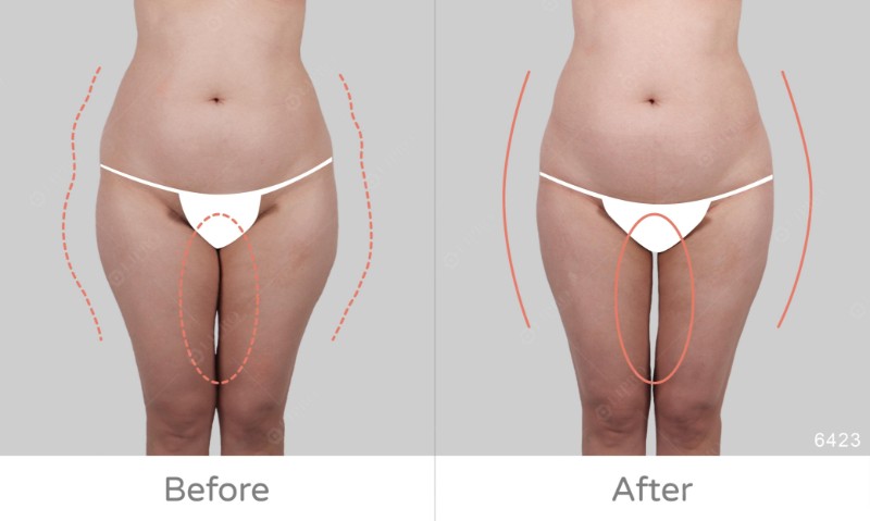 臀腿抽脂｜從XL變S曲線驚人逆轉
