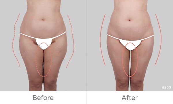 臀腿抽脂｜從XL變S曲線驚人逆轉