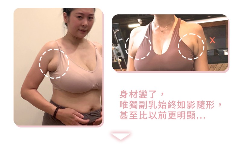 巨大副乳手術真實分享