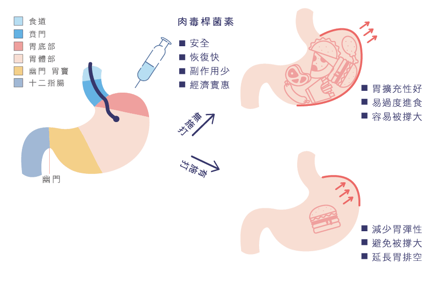 肉毒桿菌素：安全、恢復快、副作用少、經濟實惠。無施打：胃擴充性好、易過度進食、容易被撐大；有施打：減少胃彈性、避免被撐大、延長胃排空