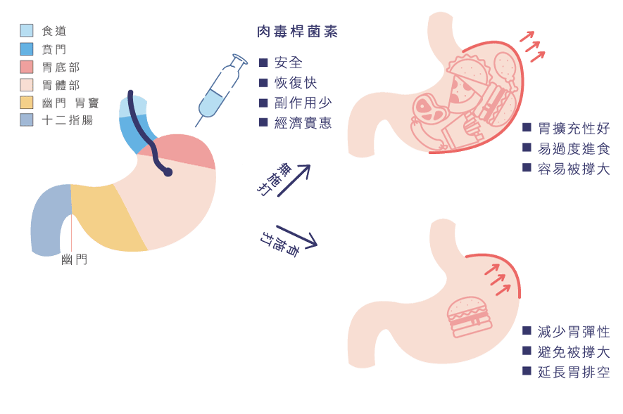 肉毒桿菌素:安全、恢復快、副作用少、經濟實惠。無施打:胃擴充性好、易過度進食、容易被撐大;有施打:減少胃彈性、避免被撐大、延長胃排空
