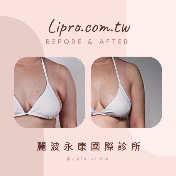 副乳手術「意外收穫」：告別副乳困擾，還能改善腋下流汗與異味？