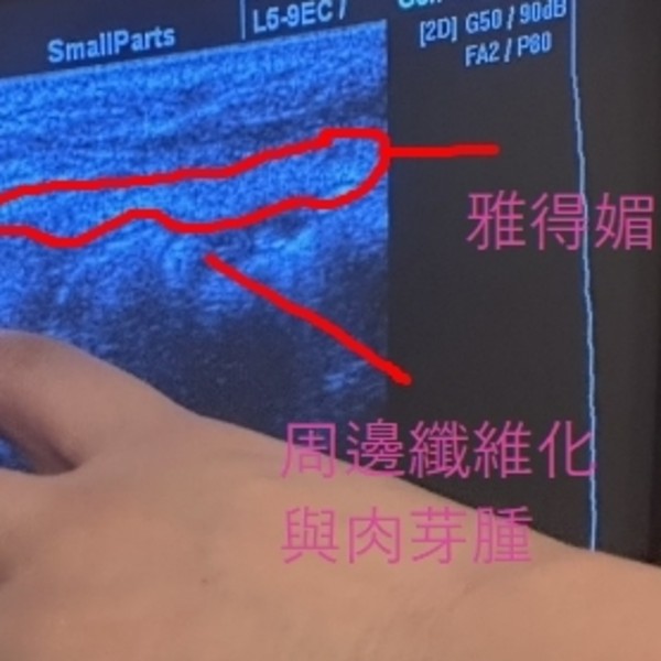 雅得媚後遺症爆發?10年前流行的「長效填充物」,如今卻成為醫師最頭痛的異物