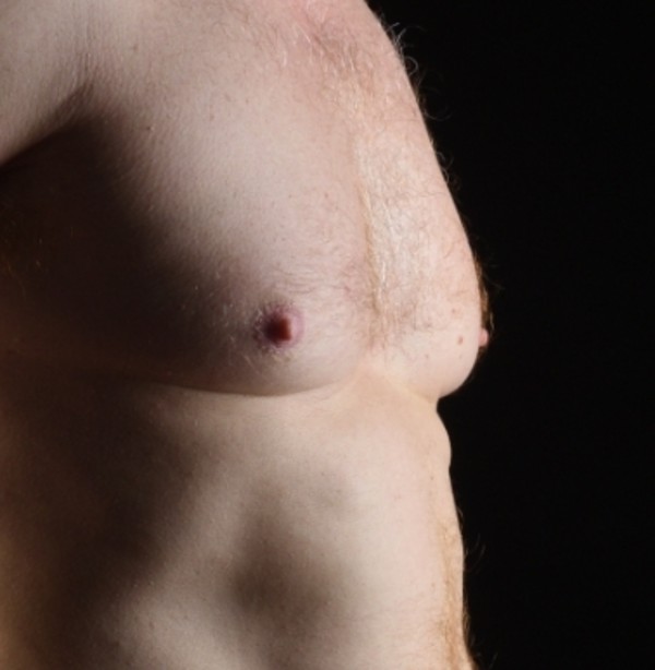 男性女乳症手術前必看！醫師提醒3種人不建議立即手術