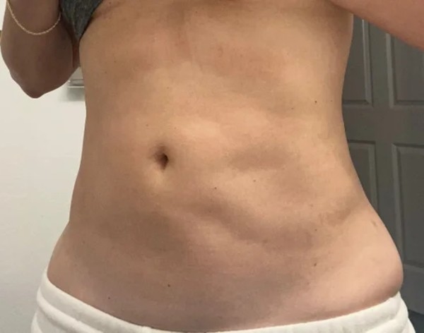 抽脂凹凸不平補救：不只是填充？玻尿酸與顯微套管的修復真相一次看懂