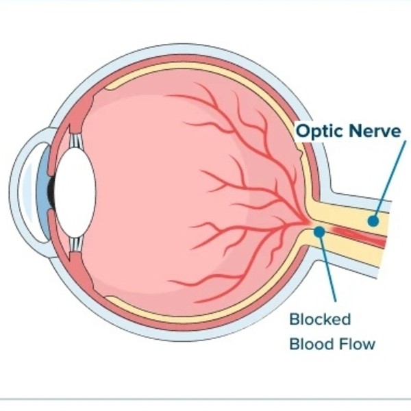 猛健樂視力模糊原因？眼中風機率、會失明嗎？3分鐘一次看懂
