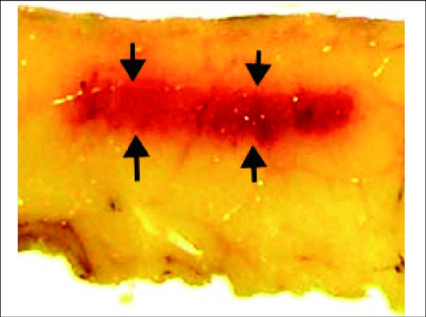 音波筋膜脆化dcard爆雷：筋膜脆化是什麼？筋膜脆化會怎樣？