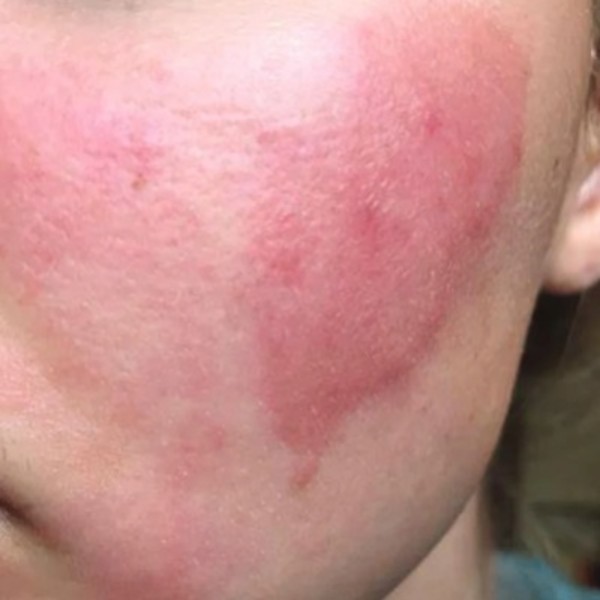 音波拉皮後遺症有哪些？30秒自測，音波燙傷/結痂SOP講清楚