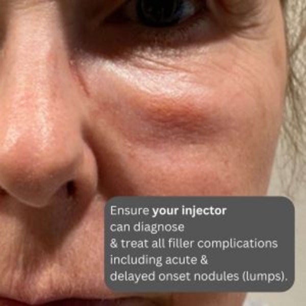 饅化Dcard血淚史：為什麼打玻尿酸凸凸的？饅化修復dcard案例真實分享