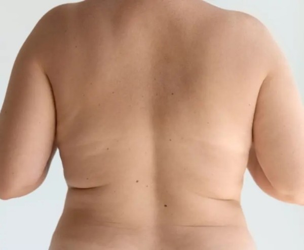 虎背熊腰怎麼瘦？虎背熊腰原因？背部抽脂前4大必看關鍵