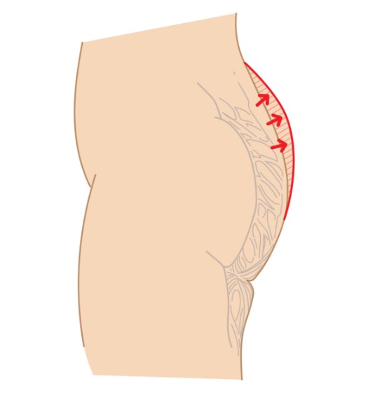 增加上臀的飽滿