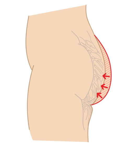 減少下臀的垂墜