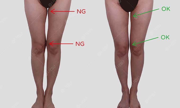 大腿環抽後中段偏瘦,大腿根部及膝蓋內側細節不足 成功個案手術前後