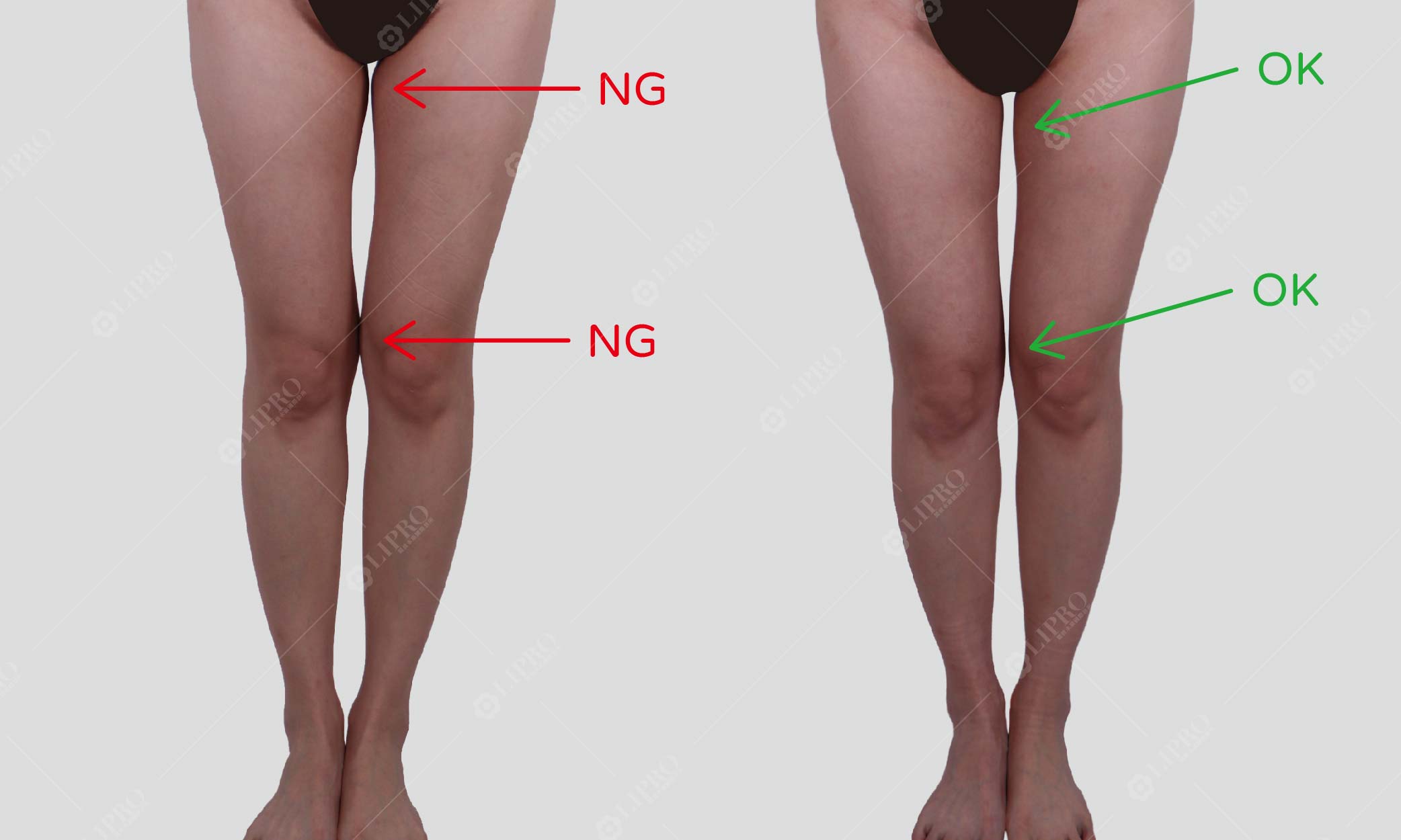 大腿環抽後中段偏瘦，大腿根部及膝蓋內側細節不足 成功個案手術前後