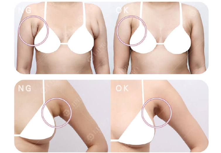 副乳手術_副乳抽脂_顯微套管抽脂_副乳消除
